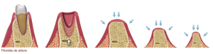 single-tooth-bone-loss2